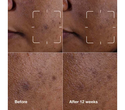 Even Better Clinical™ Dark Spot Clearing Serum 50ml