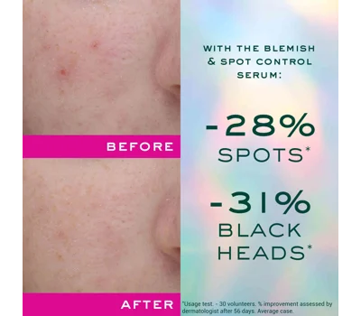 Zinc Power Anti-Blemish Anti-Pimple Serum 30ml