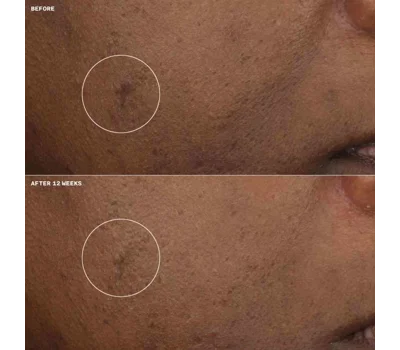 Even Better™ Clinical Brightening Moisturizer 50ml